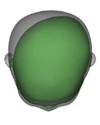 ヘルメット治療-スキャンデータ